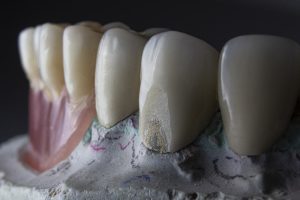 Unlock Your Smile’s Potential: The Ultimate Guide to Navigating Dental Implant Financing in Your Neighborhood